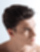 PRP Haartherapie